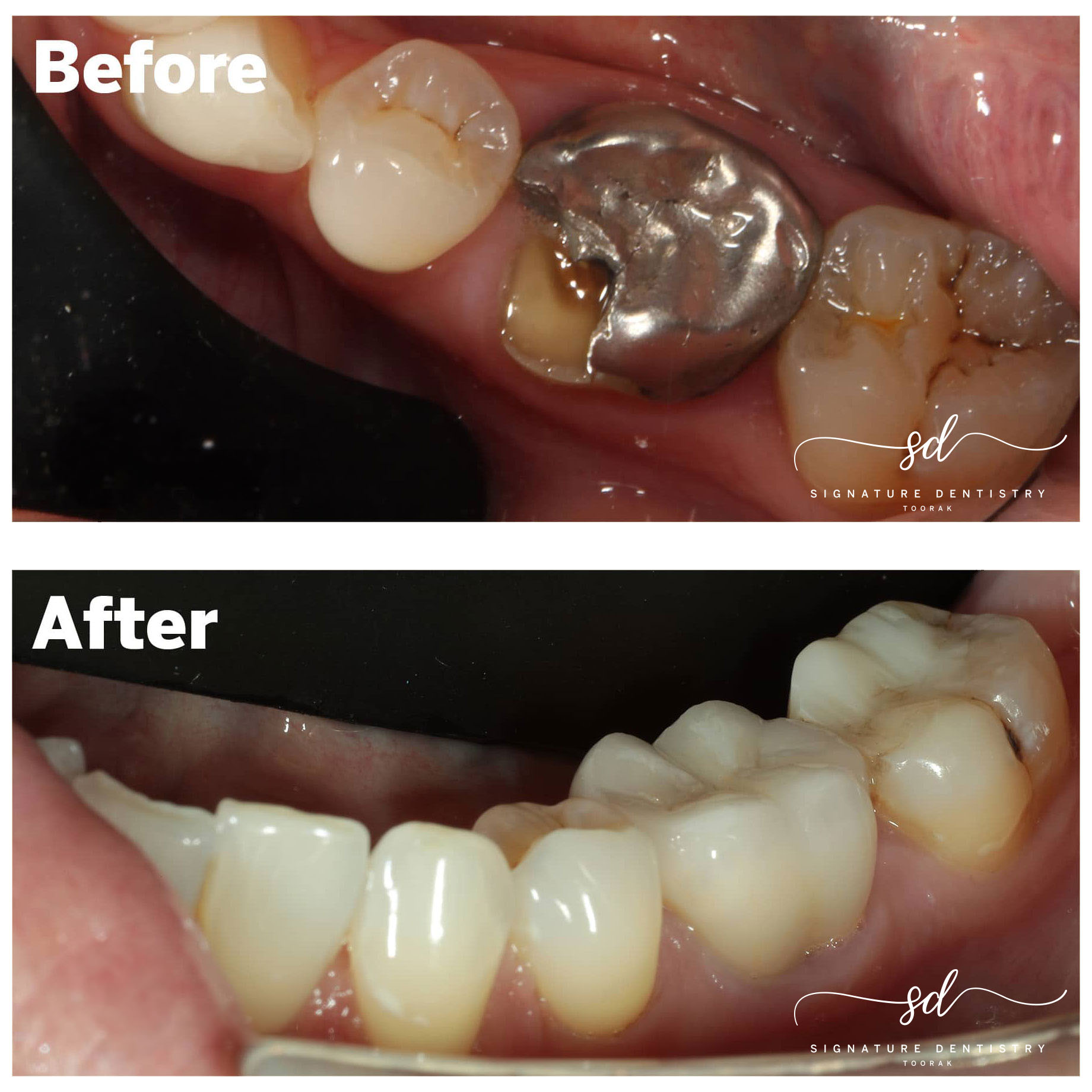Dental crown before and after at Signature Dentistry, Melbourne
