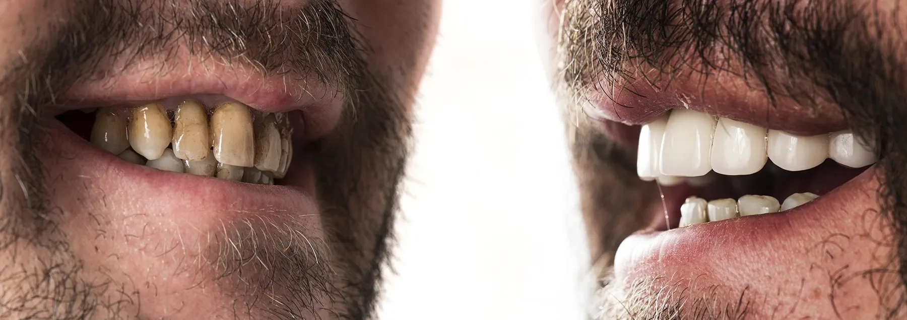 cost of porcelain veneers