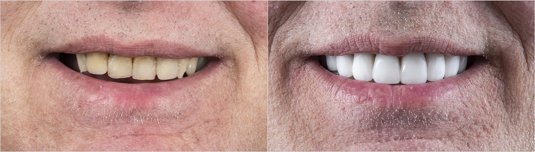 teeth veneers before and after