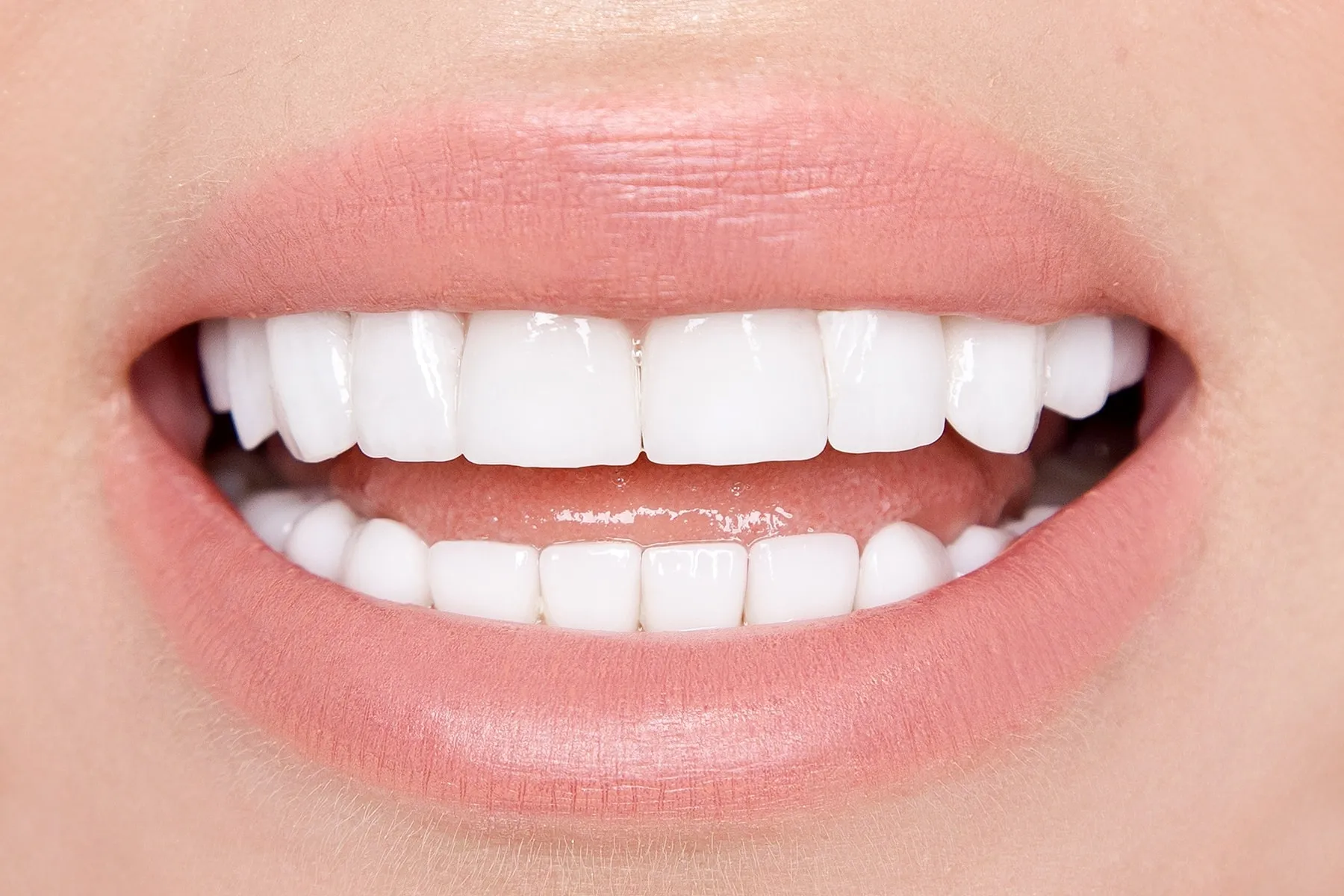 what is a veneer tooth