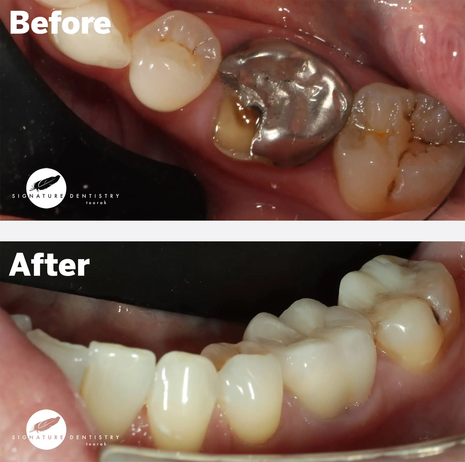 dental crowns melbourne