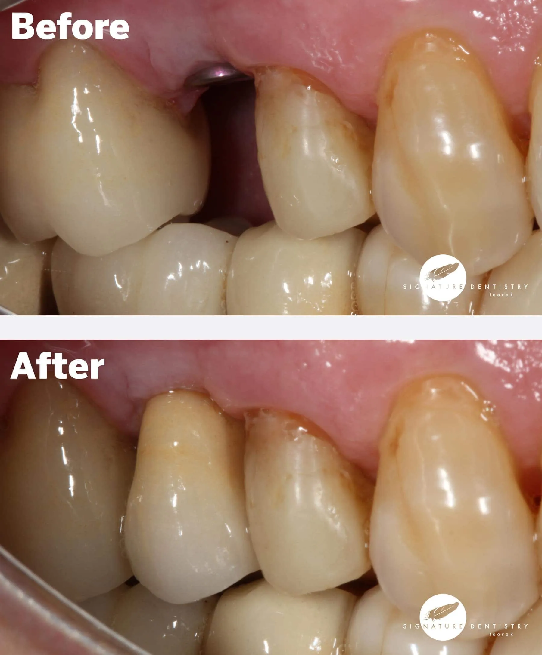 dental implants before and after