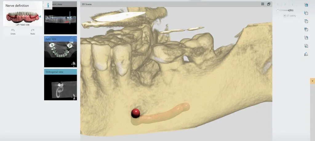dental implants cost melbourne