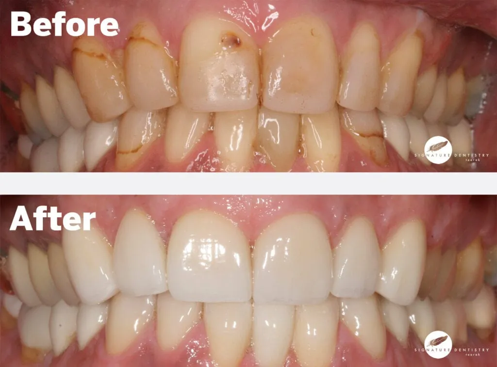 dental veneers before and after