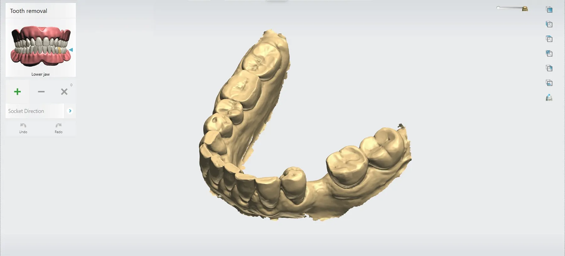 tooth implant