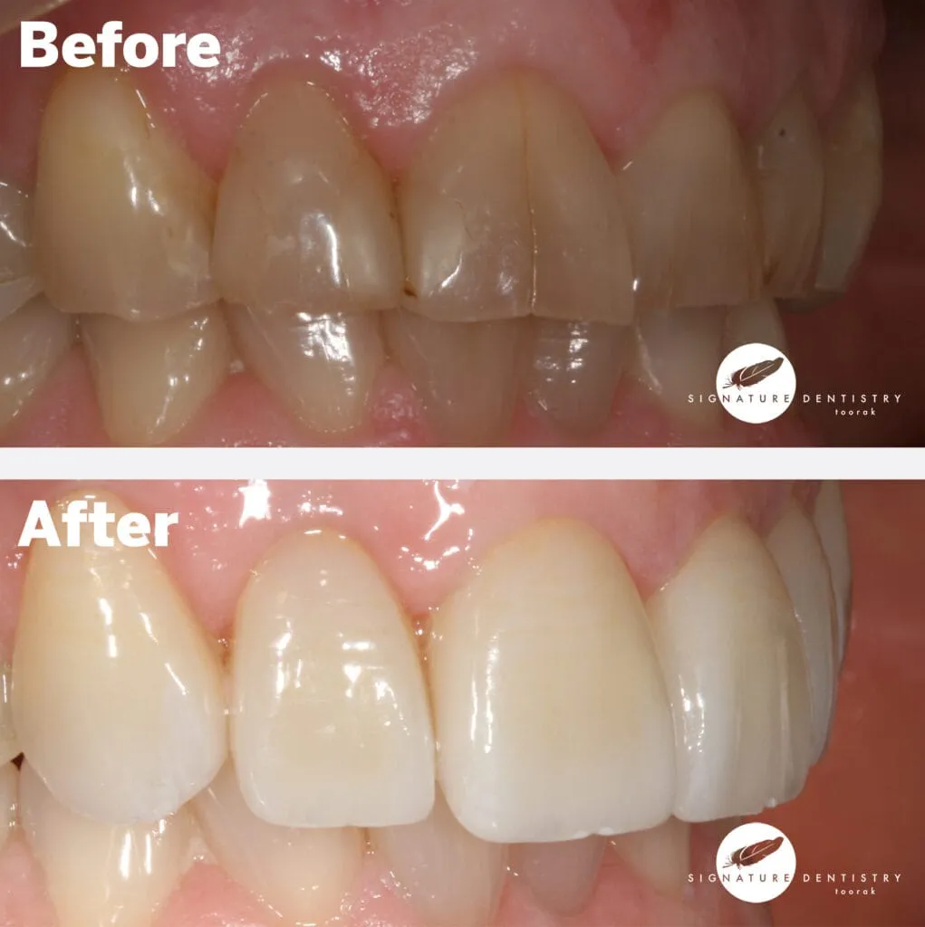 veneers before and after
