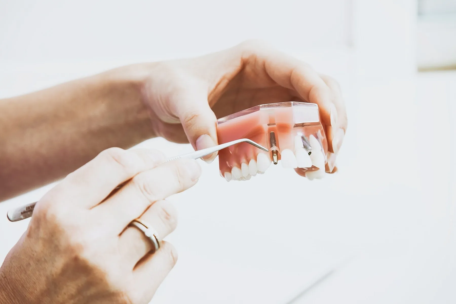 what are dental implants