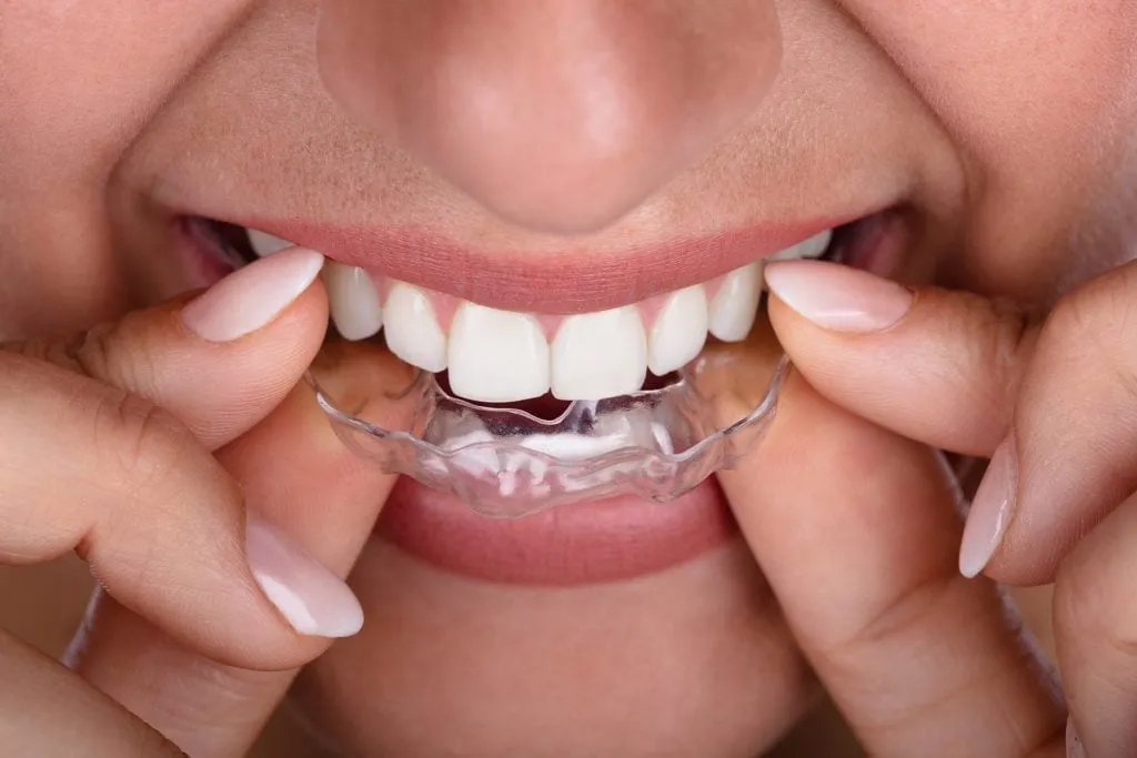 aligners