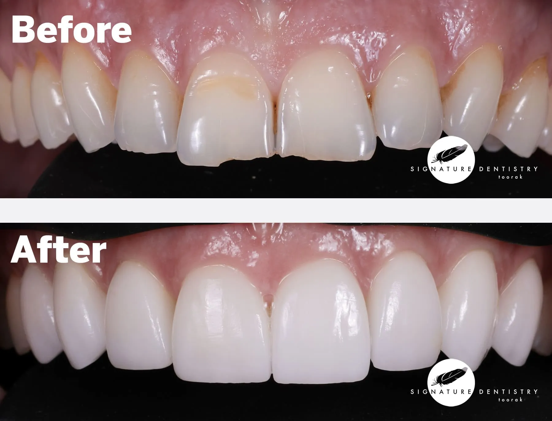 Porcelain veneers before and after — Patient Iva
