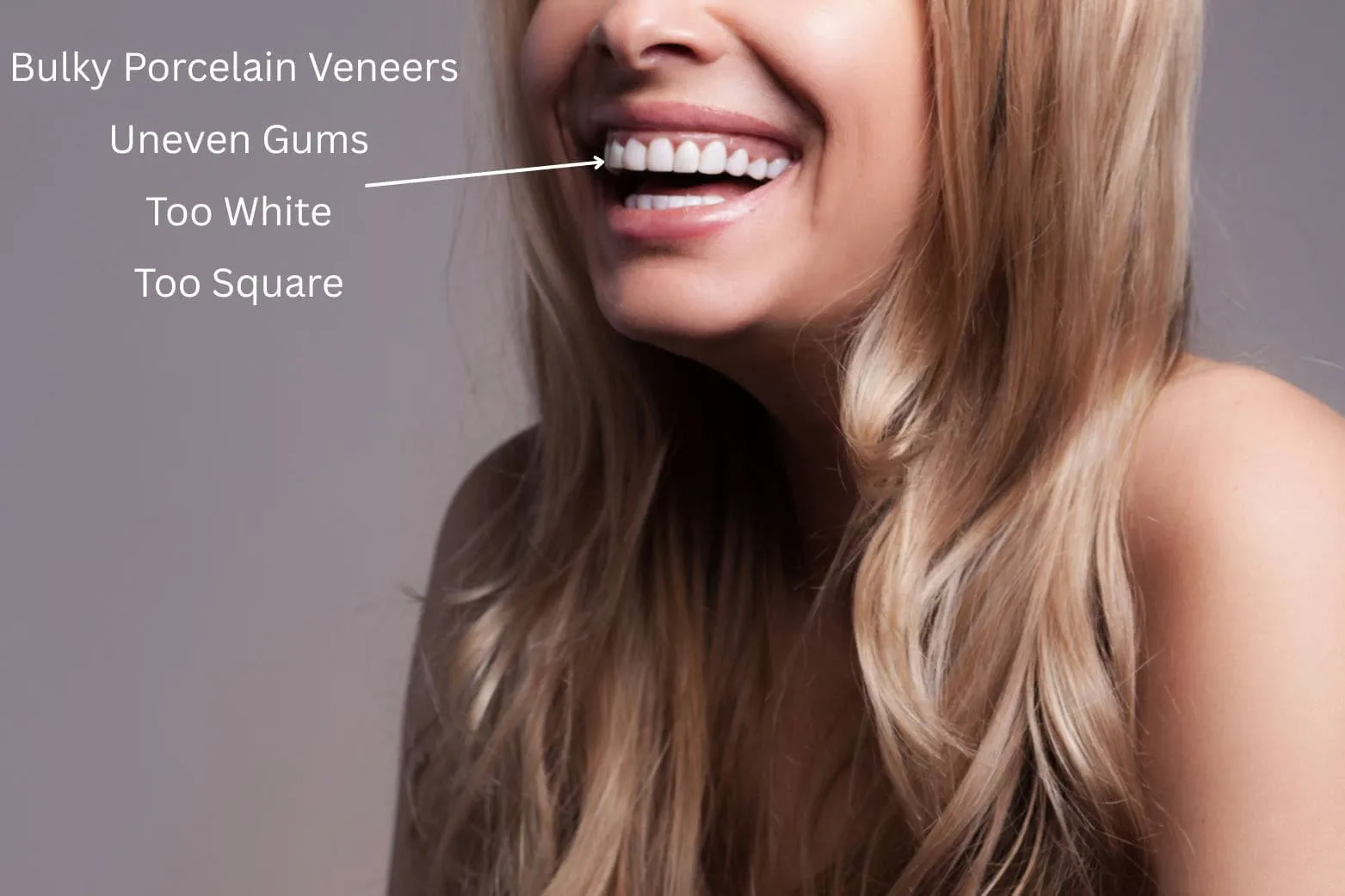 bad veneers before and after