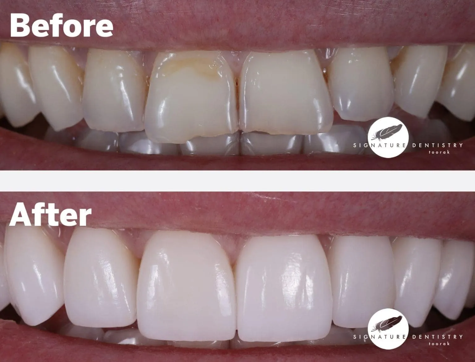 Porcelain veneers before and after — Patient Iva