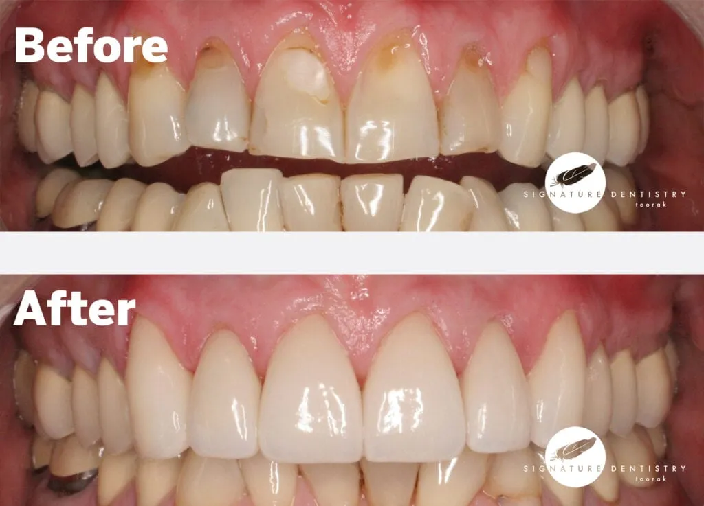 Porcelain veneers before and after at Signature Dentistry, Toorak Melbourne