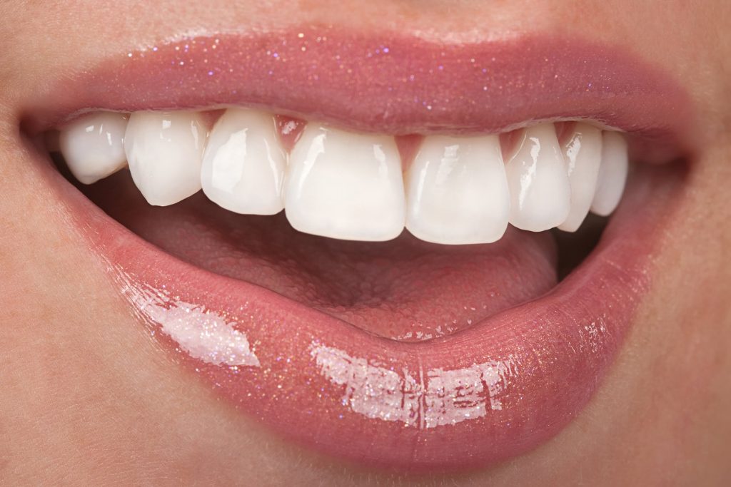 The Complete Guide to Getting Veneers
