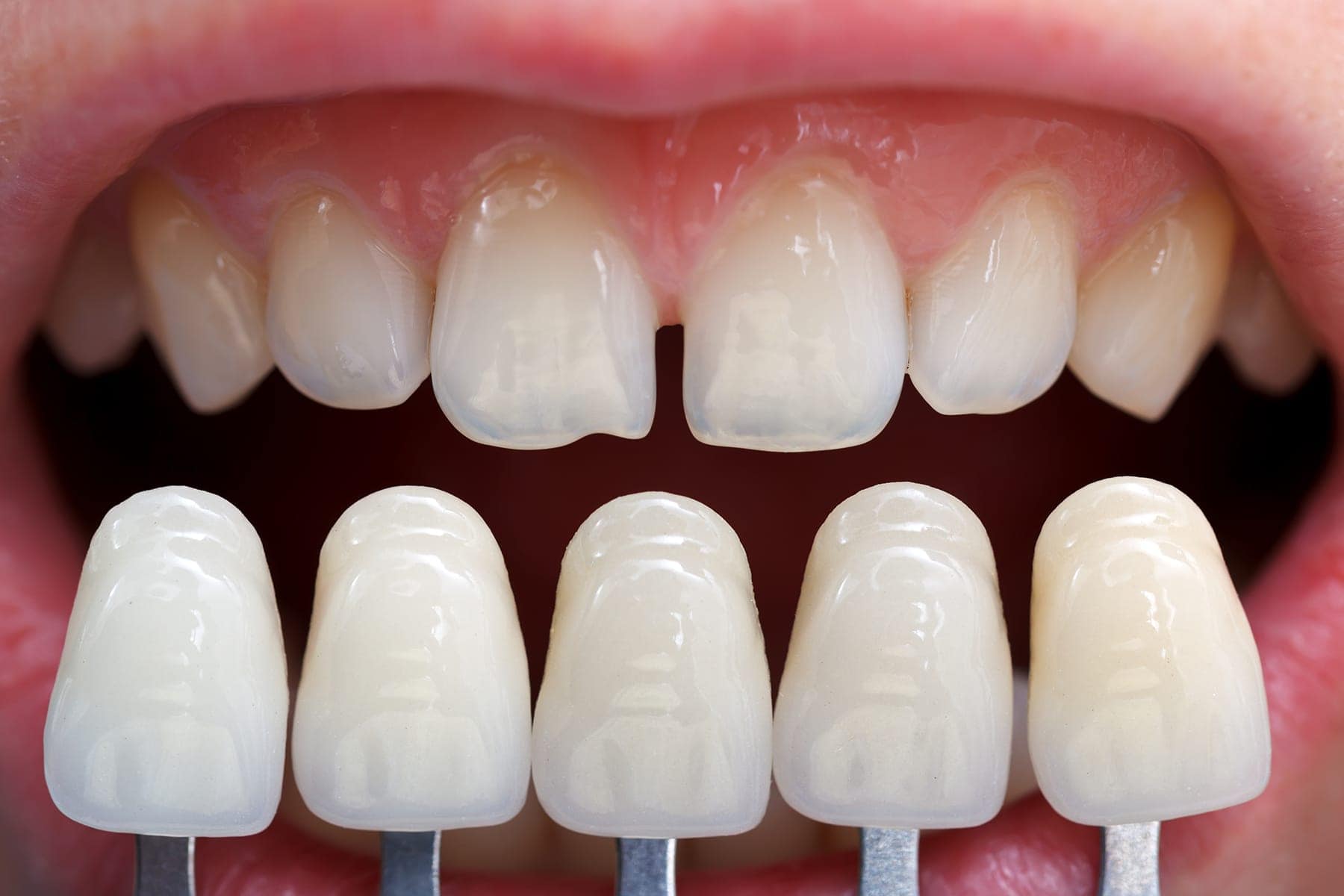 What are Dental Veneers And How Do They Work?  