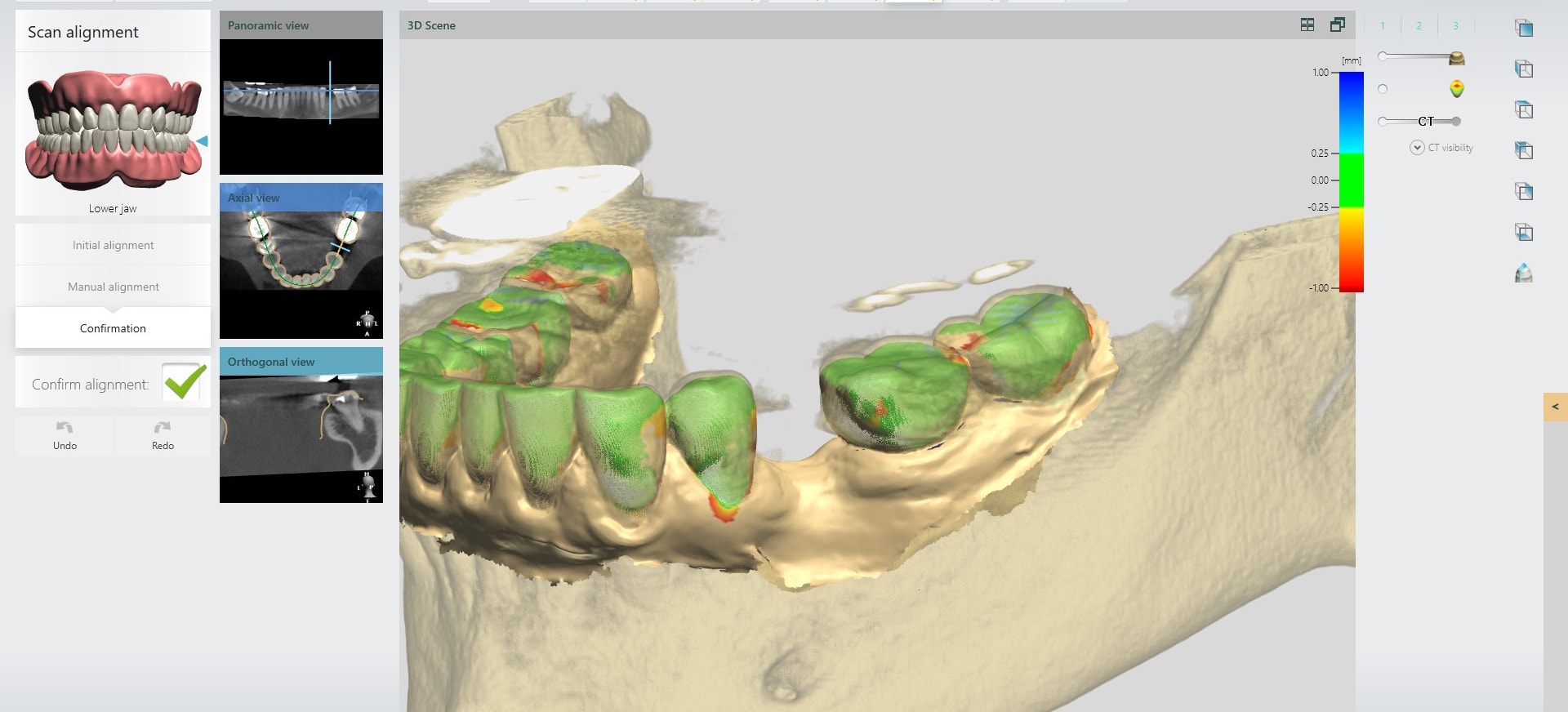 Dental Implants Melbourne Dental Implants Cost Melbourne