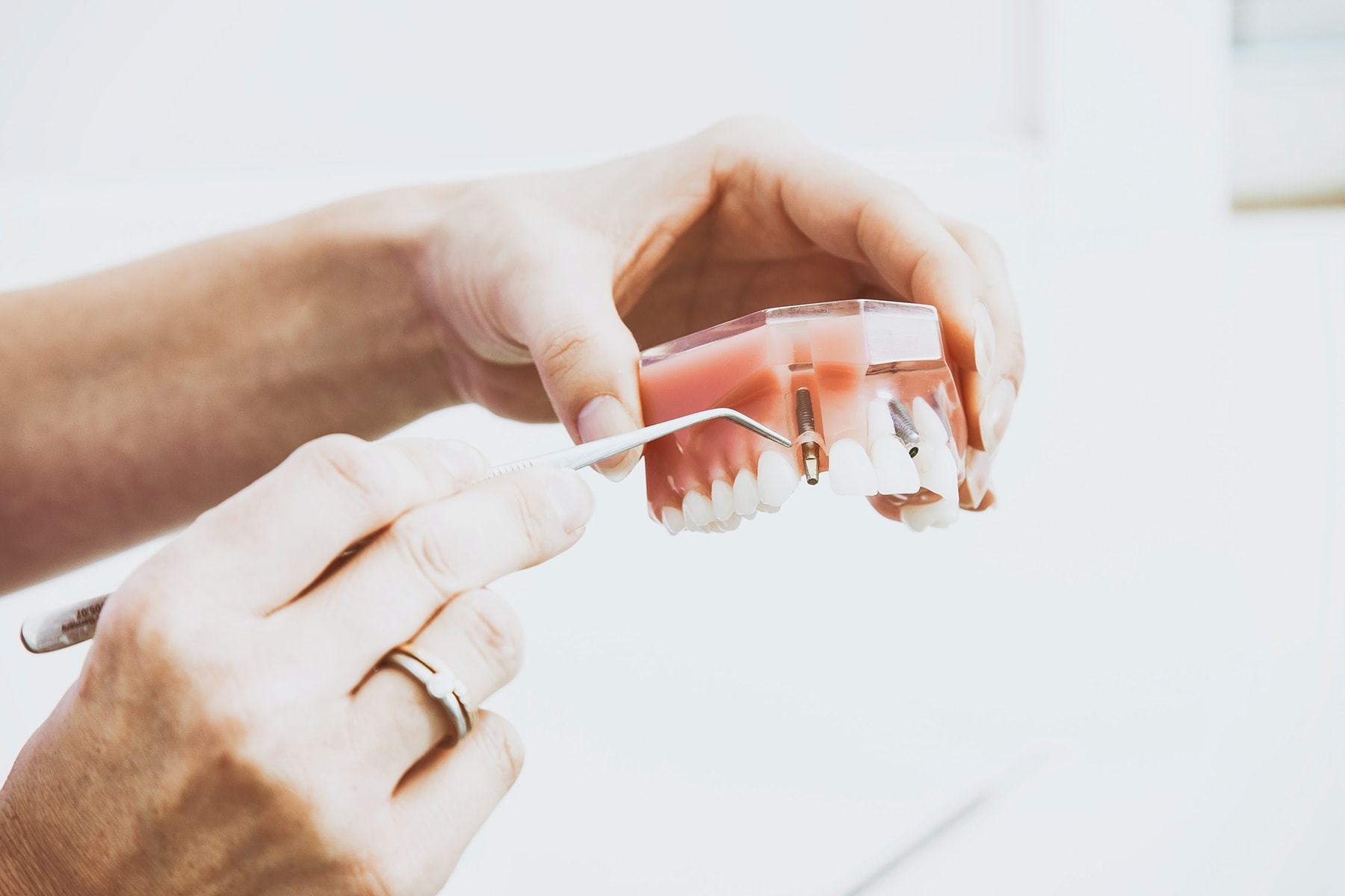 что такое зубные имплантаты