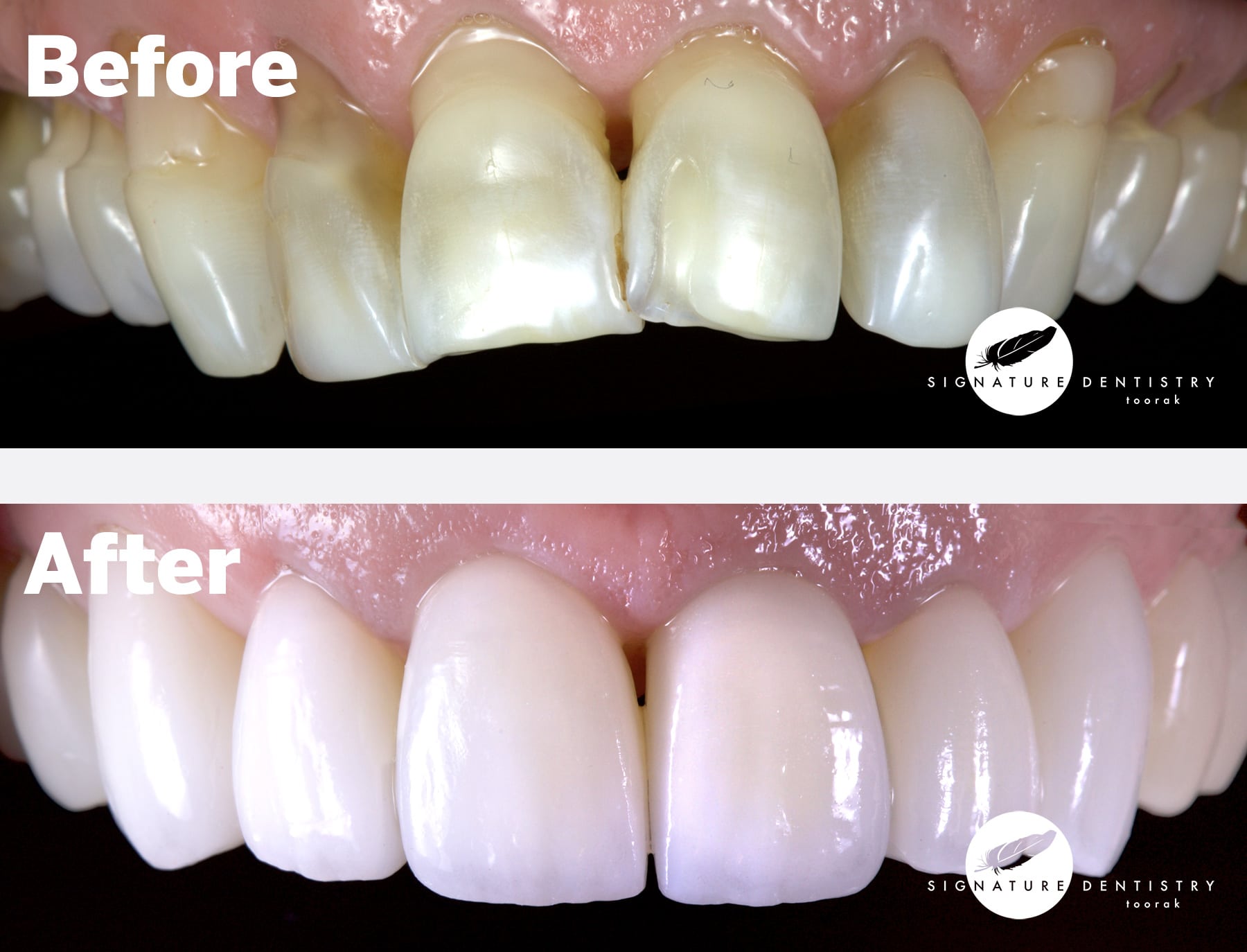 crooked teeth before and after veneers