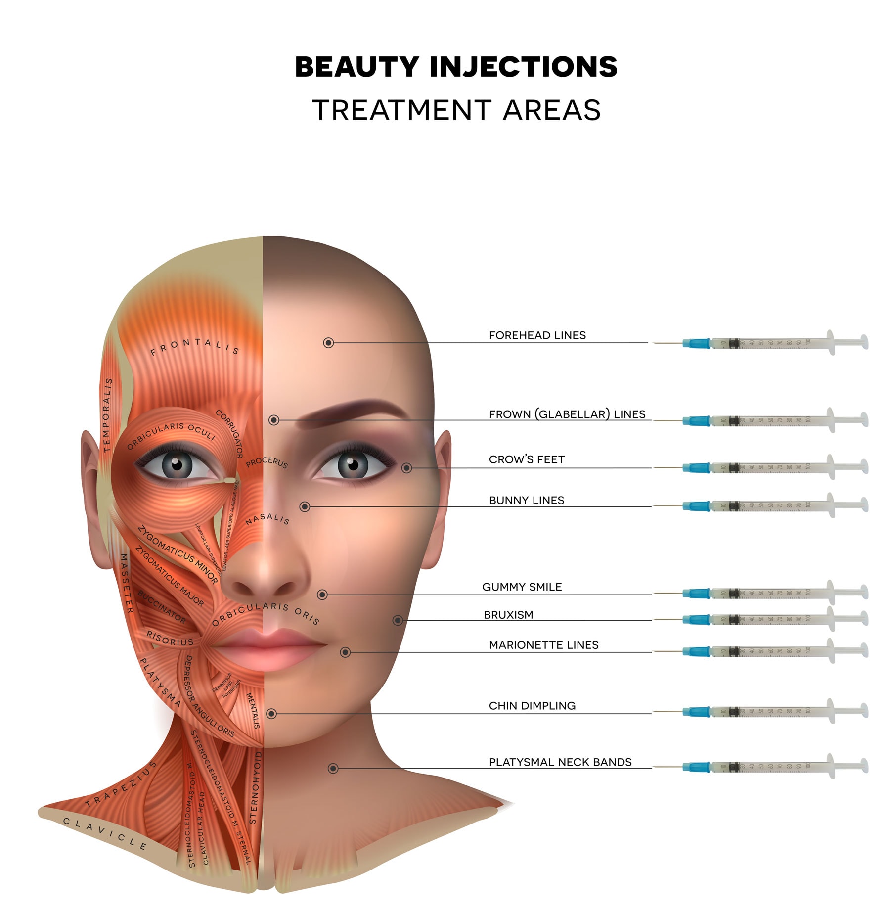 botox injection areas