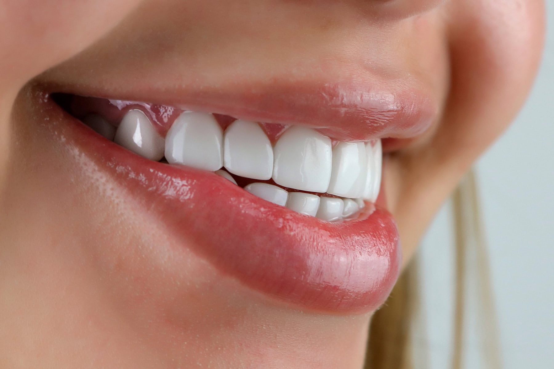 Veneers for Crooked Teeth