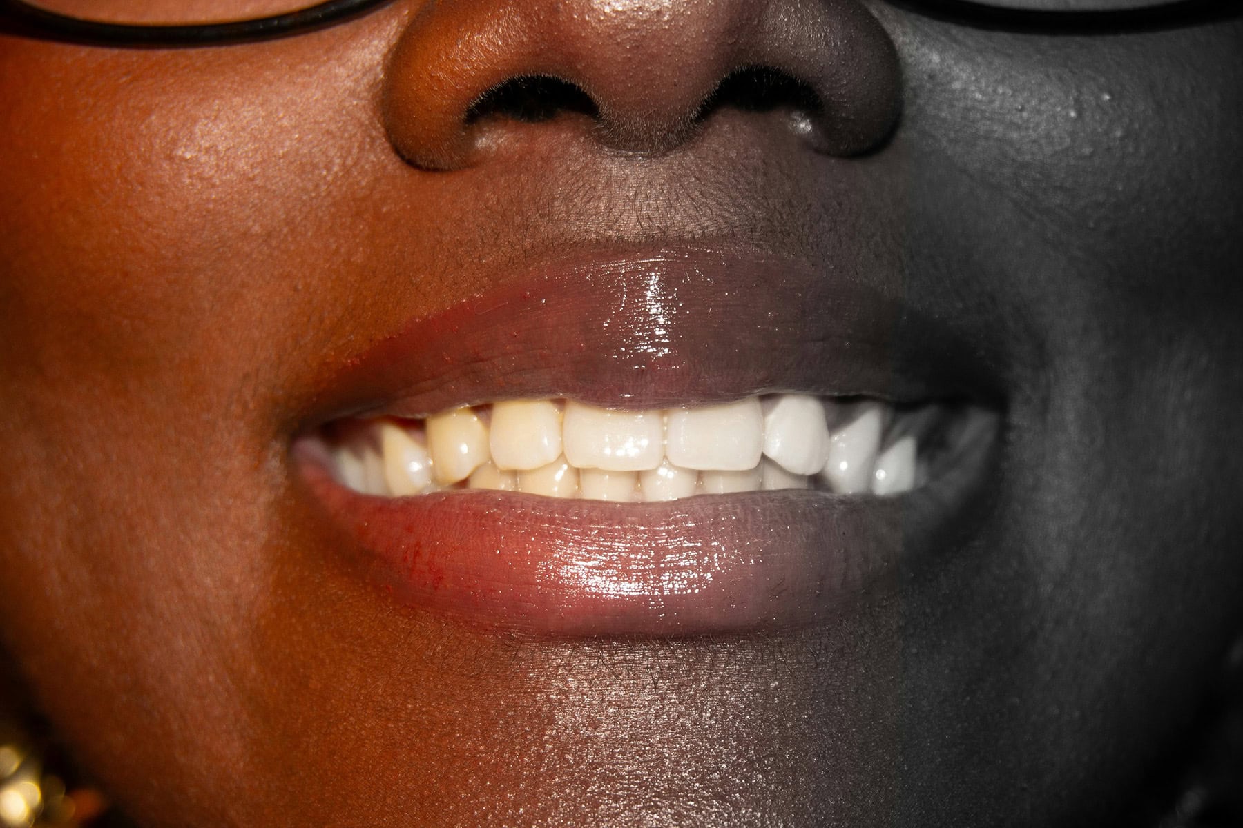 crowns vs veneers